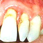 Parodontita, simptomele acesteia, prevenirea și tratamentul