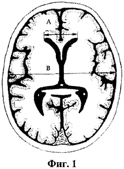 Brevetul nr. 2433782 - o metodă de predicție a dislocării creierului atunci când este comprimată