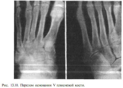 A lábfej csontjai törése - Traumatológia és ortopédia, trauma és lábkezelés -