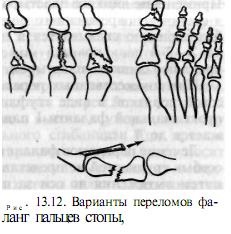 Fracturi ale oaselor din partea anterioară a piciorului - Traumatologie și ortopedie, traume și tratament picior -