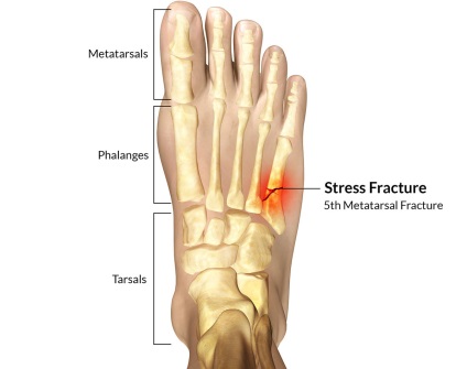 Fractura osului metatarsal al piciorului cât de mult să meargă într-o castă, reabilitare