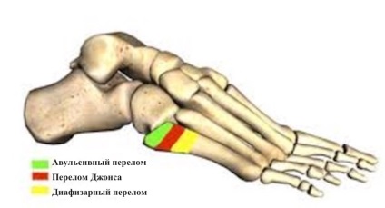 Fractura osului metatarsal al piciorului cât de mult să meargă într-o castă, reabilitare