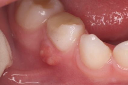 Periodontitis fogkezelés, okok, tünetek, osztályozás és differenciáldiagnózis