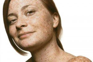 Prevenirea și tratarea petelor pigmentate prin diferite metode