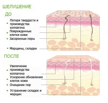 Peeling după biorevitalizare se poate face și când, ce - chimice, galben, retyenovy