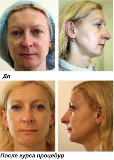 Peeling după biorevitalizare se poate face și când, ce - chimice, galben, retyenovy