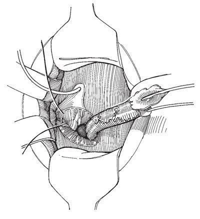 Plastica ureterocelă