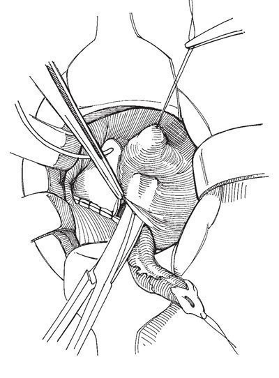 Plastica ureterocelă