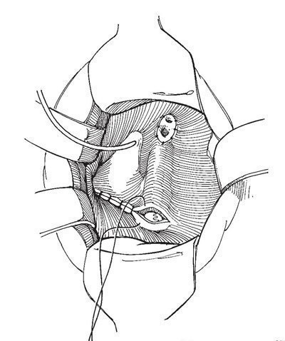 Plastica ureterocelă