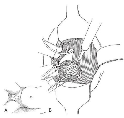 Plastica ureterocelă