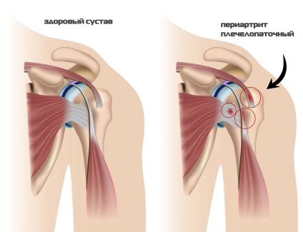 Vállfüles periarthritis