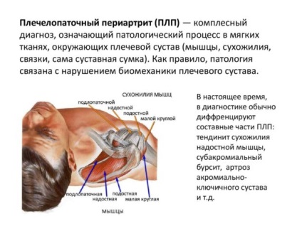 Periartrita la nivelul umărului