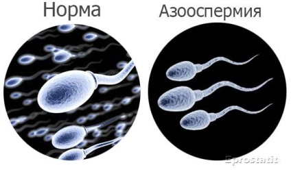 De ce sperma transparentă - cauze, diagnostic și tratament