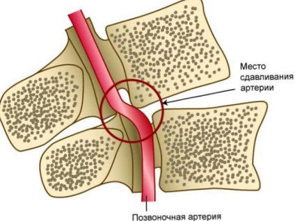 Subluxarea simptomelor și tratamentului atlasului (vertebra c1)