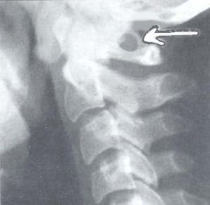A nyaki csigolya subluxációjának okai, tünetei, besorolása és kezelése