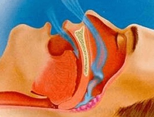 Cauzele caracteristicilor sforăitului ale respirației de noapte, mecanismul de sforăit și metodele de tratament