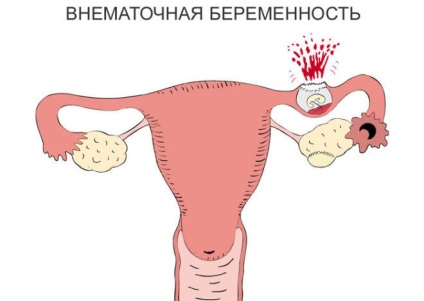 Psychometria endometriozei