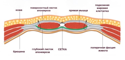 Tratamentul herniei ombilicale, intervenția chirurgicală pentru îndepărtarea - prețurile la Rostov-pe-Don, Burikov Maxim Alekseevich