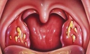 Modalități de transmitere a gâtului purulente de la o persoană bolnavă la una sănătoasă, cum poate fi transmisă unui copil