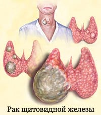 Simptome ale simptomelor cancerului tiroidian la femei, tratament, eliminare, semne, tumefierea tiroidei