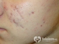 Rosacea - simptome și tratament cu remedii folclorice