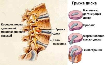 Secvență hernie, ric - Centrul de microchirurgie spinală ruso-israeliană