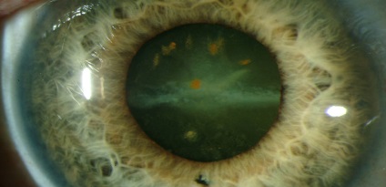 Sideroza și chalcoza (metalloza oculară) cauzează, simptome și metode eficiente de tratare a bolii
