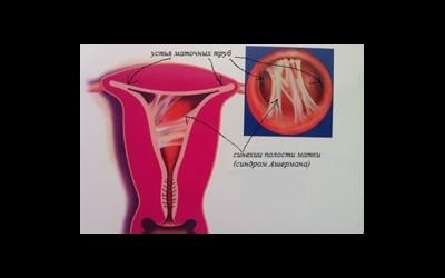 Sinechia intrauterină și metodele de tratament