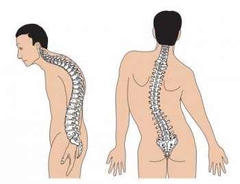 A gerinc scoliosis felnőttekben - kezelés, okok