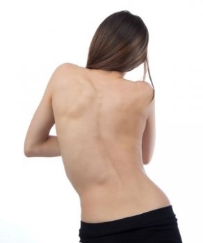 Scolioza coloanei vertebrale la adulți - tratament, cauze