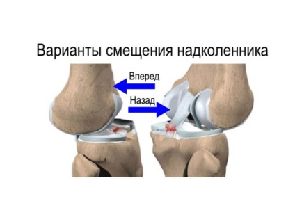 Genunchiul genunchiului - tipuri și terapii