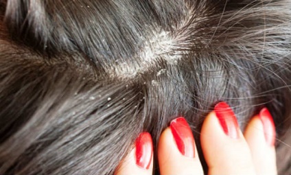 Remedii pentru seborrhea scalpului - care este mai bine să alegi și cum să aplici