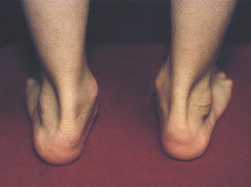 Fractura de stres a picioarelor cauzeaza si tratamentul fracturii de stres, online sanatos