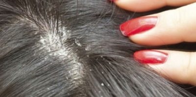 Seborrhea uscată a simptomelor scalpului și tratamentul, cum să scapi de remediile folclorice