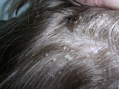 Seborrhea uscată a simptomelor scalpului și tratamentul, cum să scapi de remediile folclorice