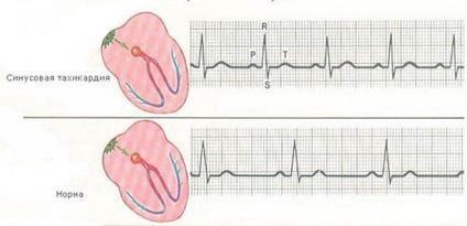 A menopauza tachycardia, annak jellemzői, kezelése és megelőzése