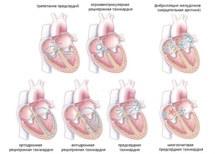 Temperatura și palpitațiile inimii la copil - cauzele și metodele de tratament