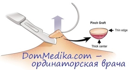 Tehnica biopsiei cutanate