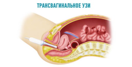 Afișarea și procedura transvaginală cu ultrasunete