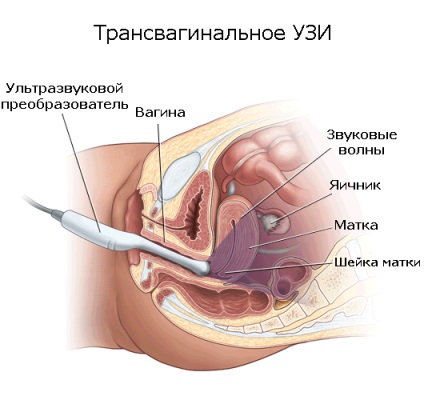 Afișarea și procedura transvaginală cu ultrasunete