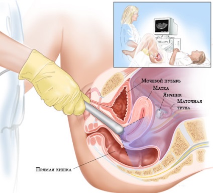 Afișarea și procedura transvaginală cu ultrasunete