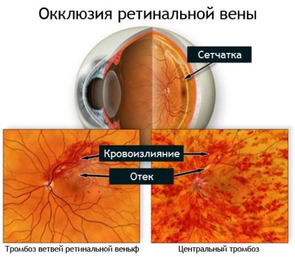 Tromboza venoasă centrală a cauzelor retinei, tratamentul și consecințele acesteia