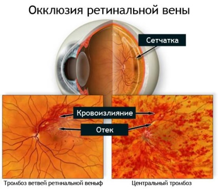 Венозна тромбоза на ретината, централните причини, лечение и последици