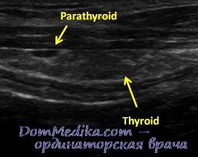 Examinarea cu ultrasunete (uzi) a glandelor paratiroide