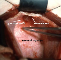 Ureterocele, urológusom