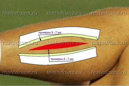 Coaserea unei plăgi pe un tencuială adezivă