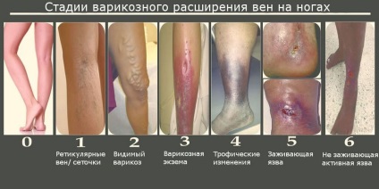 Eczema varicoasă pe picioare, site-ul medical