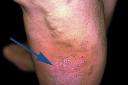 Eczema varicoasă pe picioare, site-ul medical