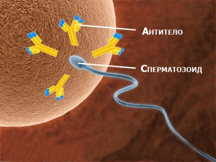 Intravascular (intravenos) leiomiatoza uterină