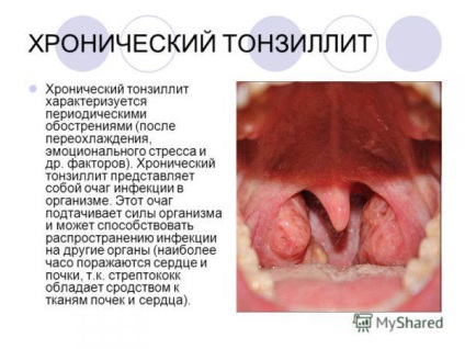 Запалення вуха лікування в домашніх умовах народними засобами, препаратами з антибіотиком, краплі